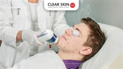 How Much Does Acne Scar Treatment Cost Clear Skin Pune