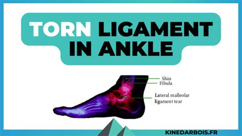 Torn Ligament in Ankle: Recovery Time & Physical Therapy Tips!