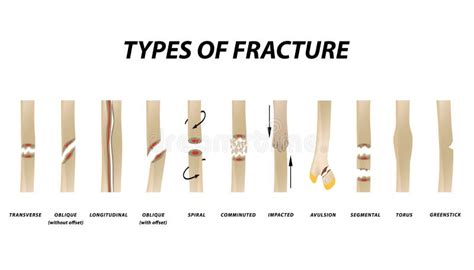 Soorten Breuk De Reeks Van Het Breukbeen Infographics Vectorillustratie