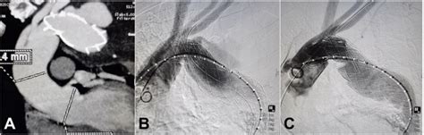 Month Follow Up Ct And Proximal Extension Graft A Follow Up Ct