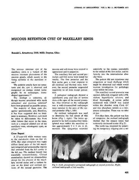 Pdf Mucous Retention Cyst Of Maxillary Sinus Dokumen Tips