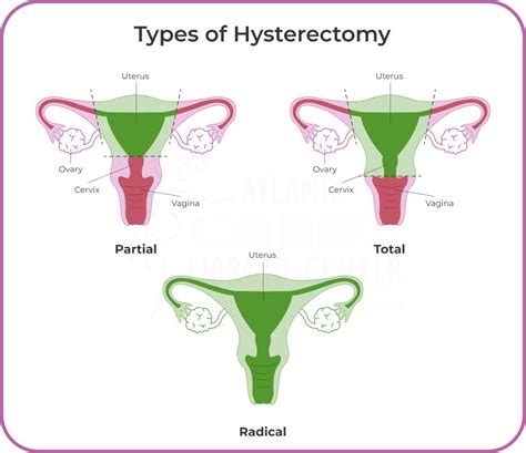 Understanding Total Hysterectomy A Patient S Perspective