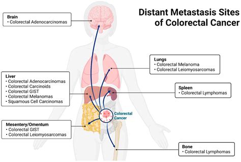 Cancers Free Full Text Bacterial Involvement In Progression And