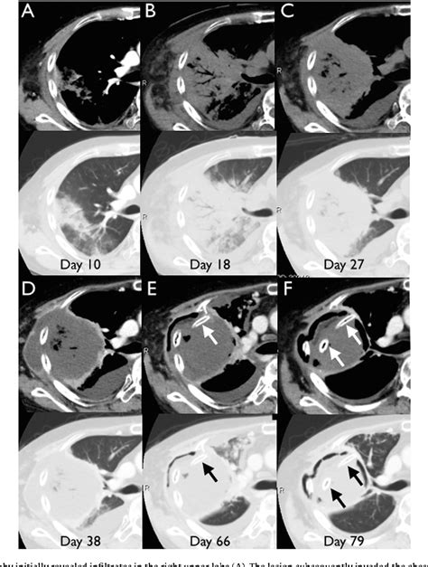 Figure 1 from A massive cavitary lesion invading the chest wall. | Semantic Scholar