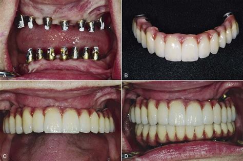 30 Maxillary Arch Fixed Implant Prostheses Pocket Dentistry