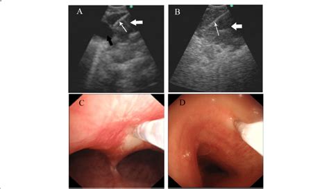 Endobronchial Ultrasound Guided Tbna Ebustbna A The Ultrasound Image