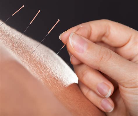 What Is Acupuncture Active Osteopathy