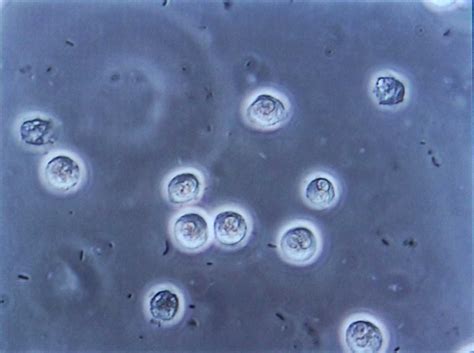 Bacteriuria - Wikiwand