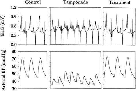 Cardiac Tamponade Ecg