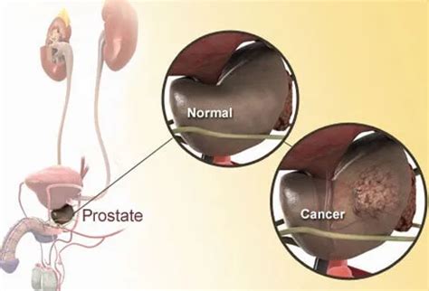 Enlarged Prostate BPH Warning Signs Treatment Causes Surgery Test