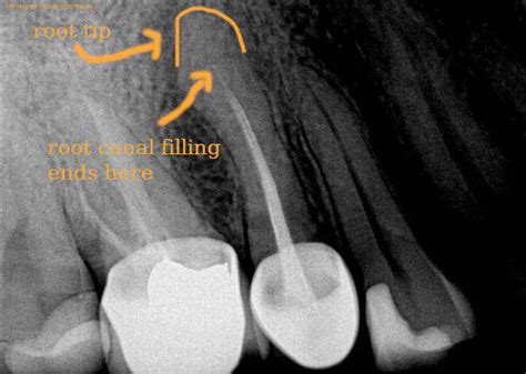 Failed Root Canals On X Rays What To Do Jackson Ave Dental