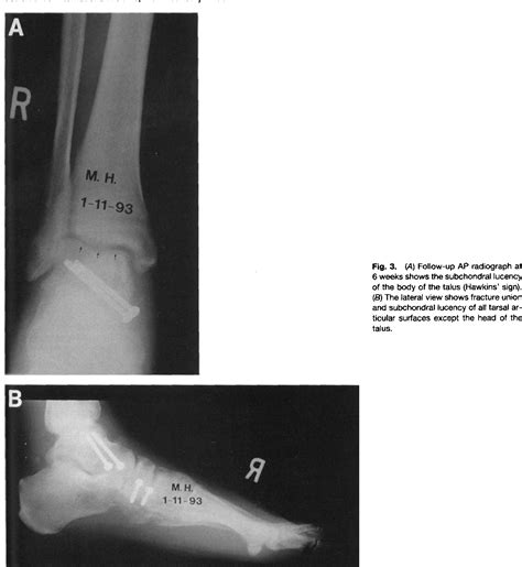 Figure 1 from Talar Neck Fracture with Talar Head Dislocation and Intact Ankle and Subtalar ...