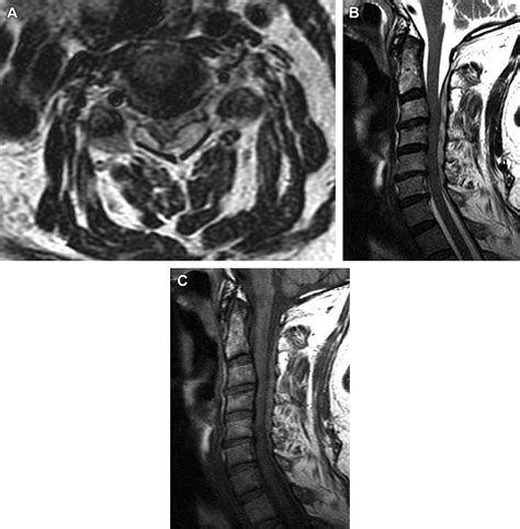 Imaging Of The Postoperative Spine An Issue Of Neuroimaging Clinics 1e The Clinics Radiology 10