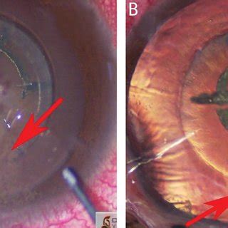 Axial Length Axl And Anterior Chamber Depth Acd Without Conversion