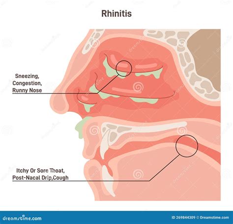 Runny Nose Anatomy