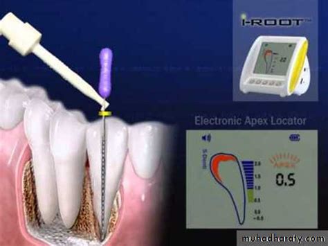 Endodontics Pptx Dr Abd Al Adheem Muhadharaty