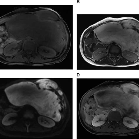 Contrast Enhanced Abdominal Computed Tomography A Transverse View Of