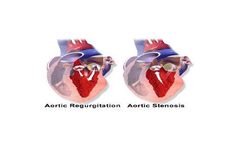 Aortic Insufficiency Symptoms, Treatment, Prevention - Booboone.com