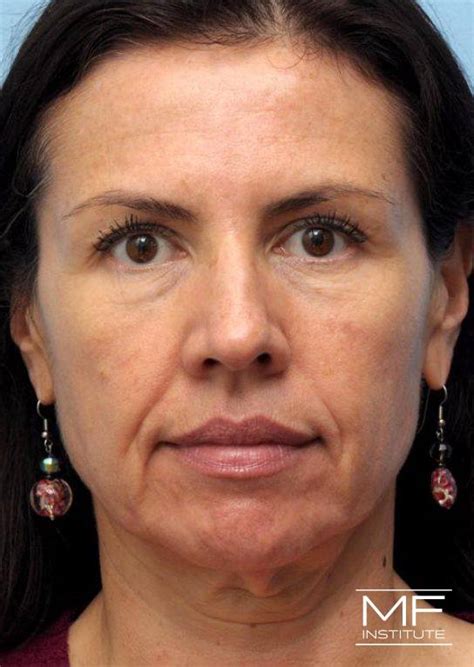 Lower Face Rejuvenation Botox® And Filler For Marionette Lines And Jowls