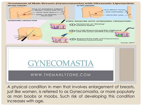 Ppt Gynecomastia Powerpoint Presentation Free Download Id 7314473