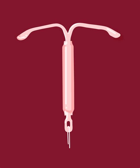 Mirena IUD Removal Female Contraceptive Personal Story