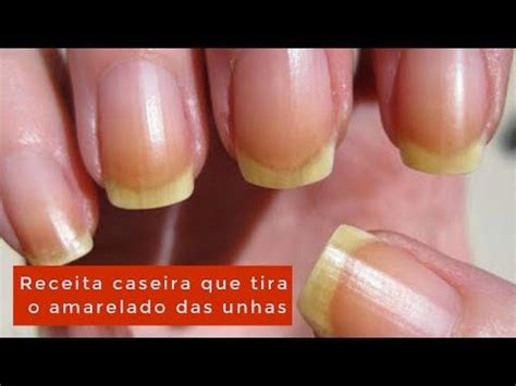 Unhas Amarelas Como Tirar - Como Tirar O Amarelado Das Unhas | Ligados Nas Dicas | Nail ...
