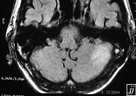 Left Sigmoid Sinus Thrombosis Radiopaedia