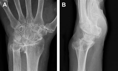 current concepts   treatment  rheumatoid arthritis   distal