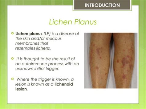 Solution Lichen Planus Ppt Studypool