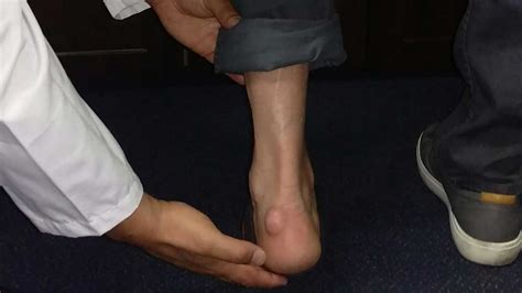 Bump On Heel Of Foot That Hurts Hotsell | emergencydentistry.com