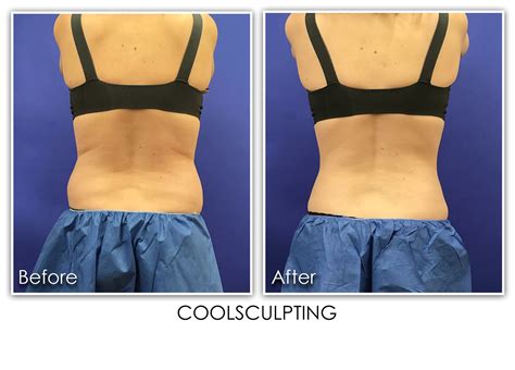 Coolsculpting Pro Archives Skin Rejuvenation Clinic Skin Rejuvenation