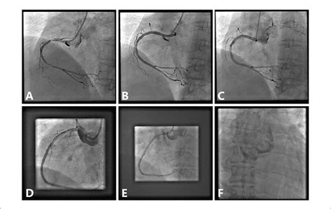 Scielo Brasil Percutaneous Management Of Iatrogenic Aortocoronary