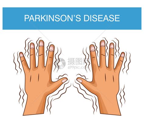 Parkinsons