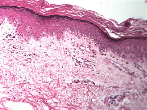 Punch Biopsy Showing Irregular Atrophy Of Epidermis Basal Cell