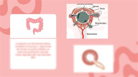 Solution Enfermedad Diverticular Studypool