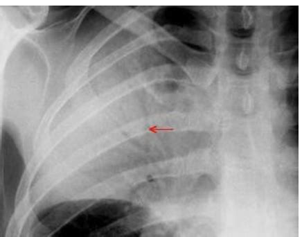 Chest Xray Flashcards Quizlet