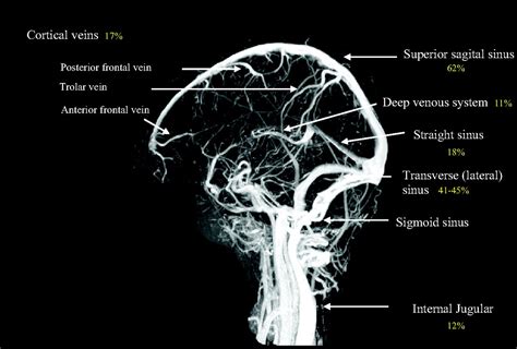 Diagnosis And Management Of Cerebral Venous Thrombosis Stroke