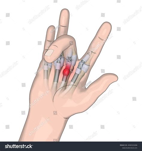 Trigger Finger Illustration Finger Anatomy Hand Ilustrações Stock