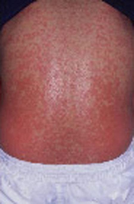 Hiv Patient Rash