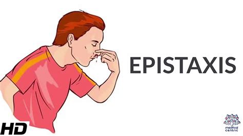 Epistaxis, Causes, SIgns and Symptoms, Diagnosis and Treatment. - YouTube