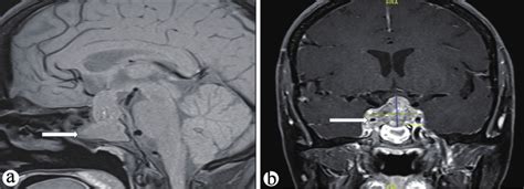 A T1 Weighted MRI Sagittal Images Showing Large Intrasellar Mass