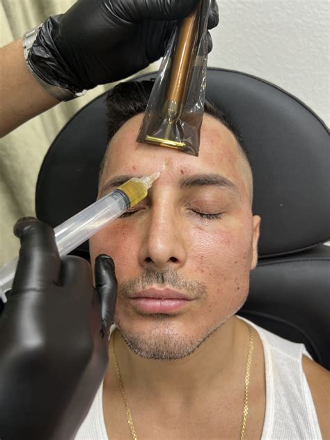 Platelet Rich Plasma Face Galan Aesthetics