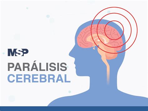 Par Lisis Cerebral