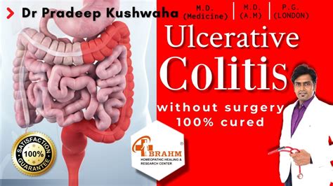 Ulcerative Colitis Treatment And Symptoms Without Surgery 100 Cured