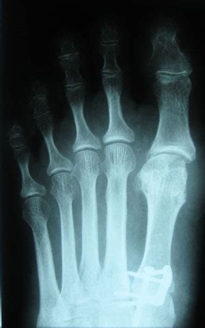 Hallux Valgus M Nchen Konservativ Operative Behandlung