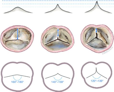 Repair Oriented Surgical Classification For BAVs Symmetric