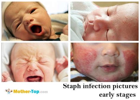 staph infection pictures early stages