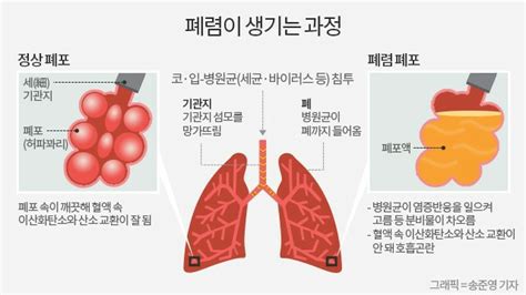 ♠ 폐렴의 증상 원인 진단 치료 예방 ♠ 폐렴은 한쪽 또는 양쪽 폐 조직에 염증이 생기는 것으로 대개 박테리아 감염