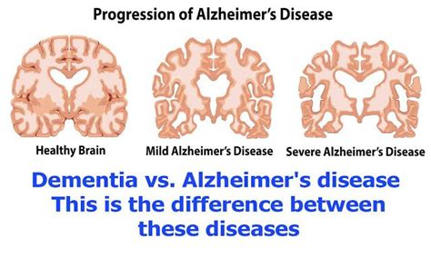 Dementia Vs Alzheimers Disease This Is The Difference Between These