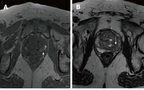 T1 A And T2 Weighted Images B Of The Midgland Of The Prostate The